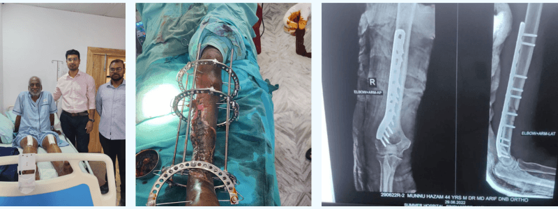 Knee Replacement Surgery