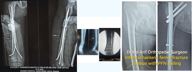 ACL Reconstruction